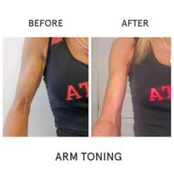 Before and After images of Arm Toning