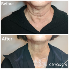 Before and After images of CryoSkin's effects on a neck